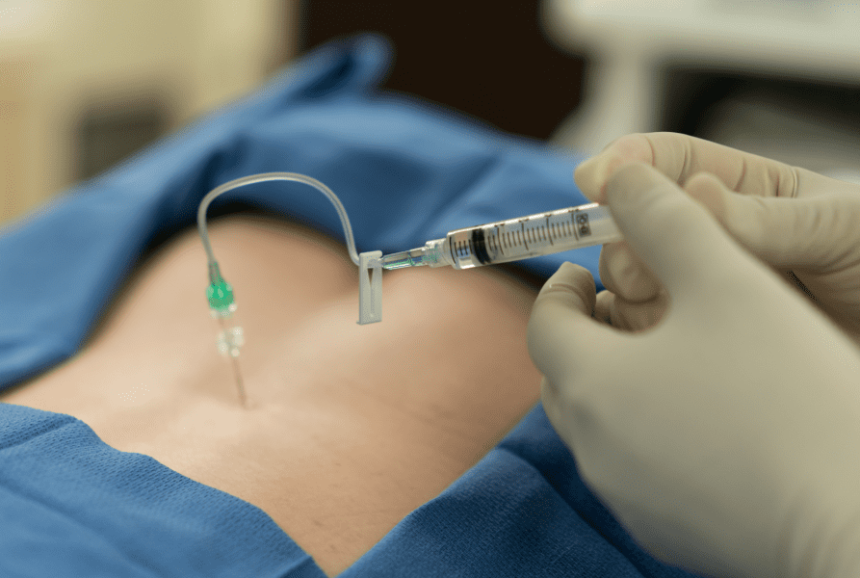 Epidural Steroid Injections