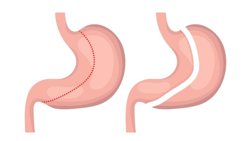 Gastric Sleeve Surgery