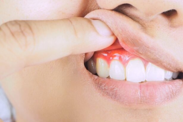 Periodontal Disease