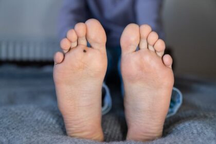 Plantar Warts