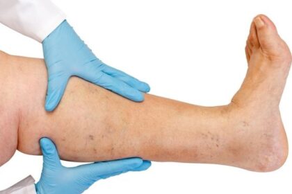 Venous Ulcers