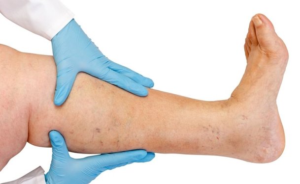 Venous Ulcers