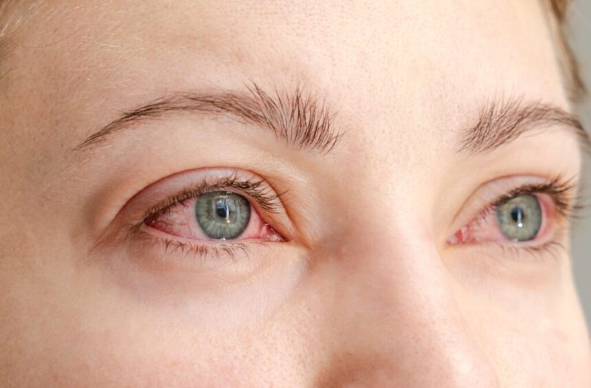 Allergies Can Affect Your Eyes and Vision