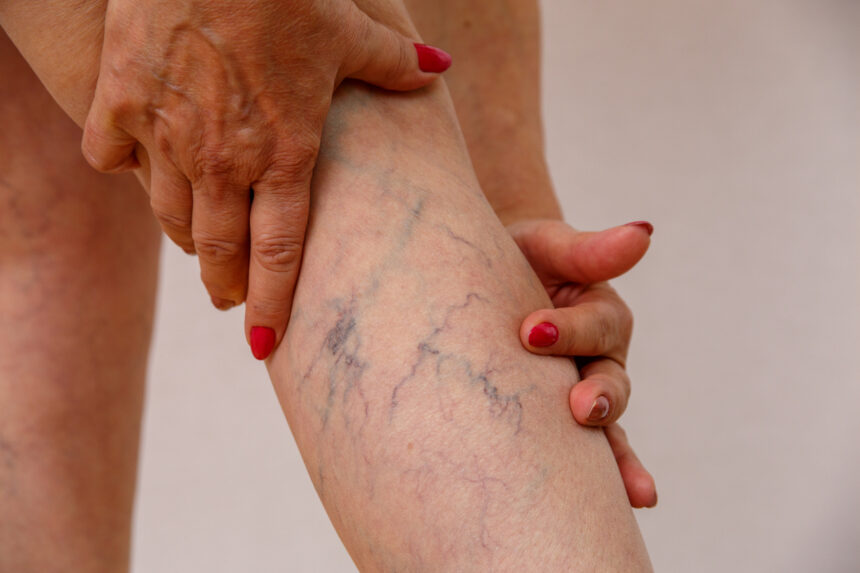 Common Vascular Problems