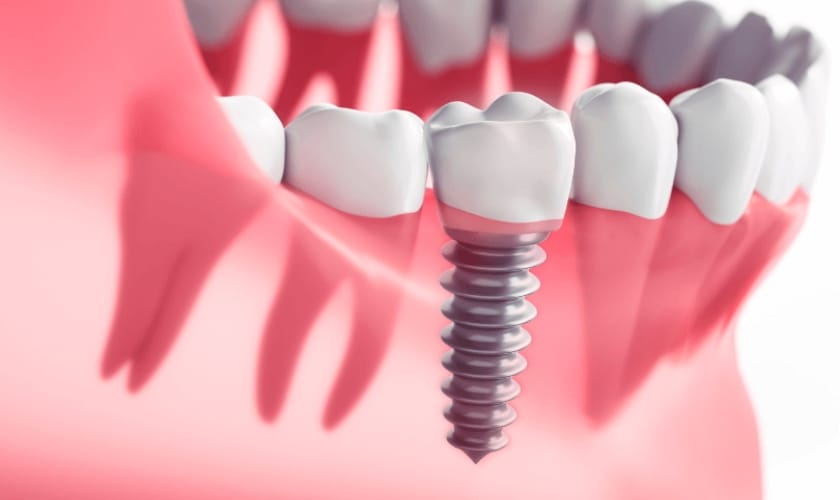 Dental Implants