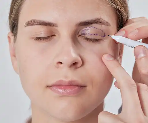 Eyelid Surgery