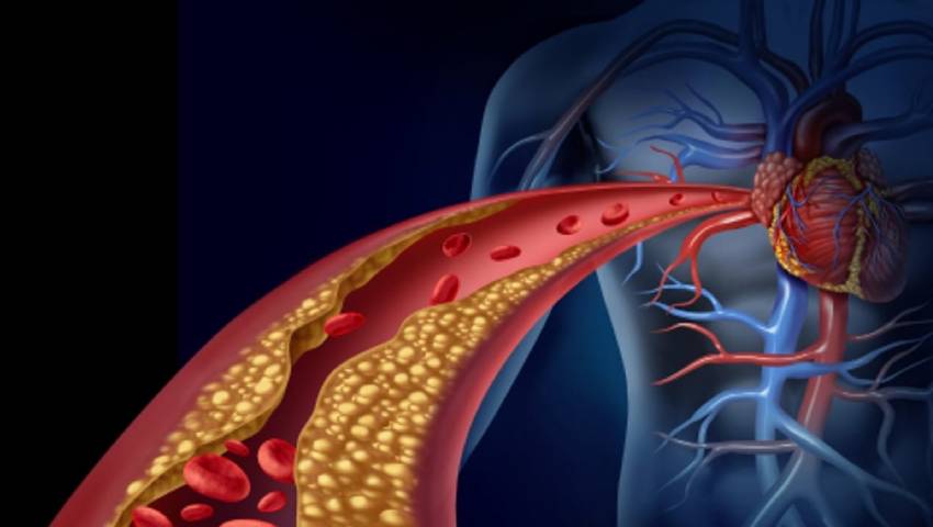 High Cholesterol and Heart Disease