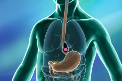 Navigating Cancer Care Resources for Esophageal Cancer