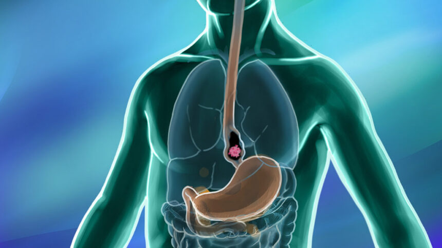 Navigating Cancer Care Resources for Esophageal Cancer