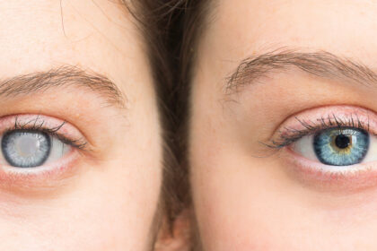 Undergoing Cataract Surgery