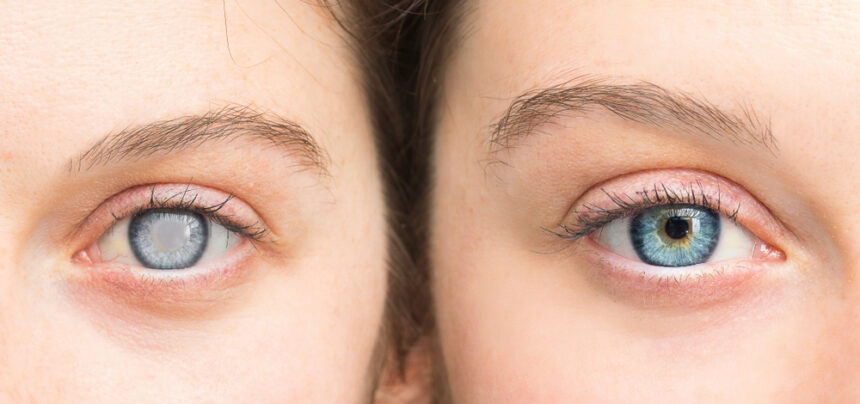 Undergoing Cataract Surgery