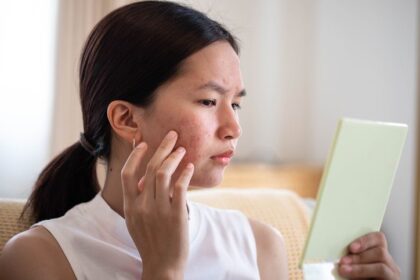 Acne Treatment