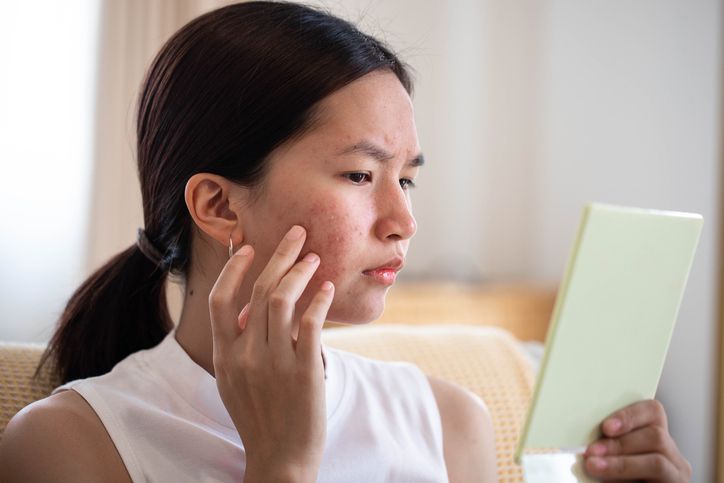 Acne Treatment
