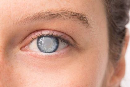 Early Signs of Cataracts