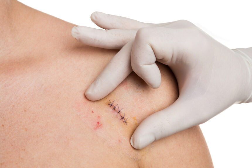 Mohs Surgery