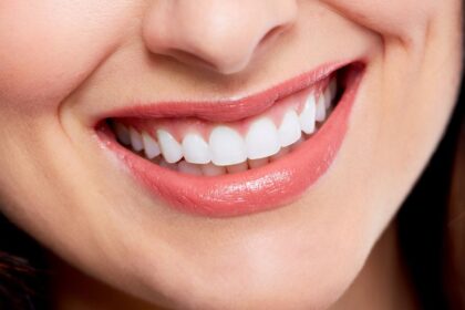 Smile Makeover