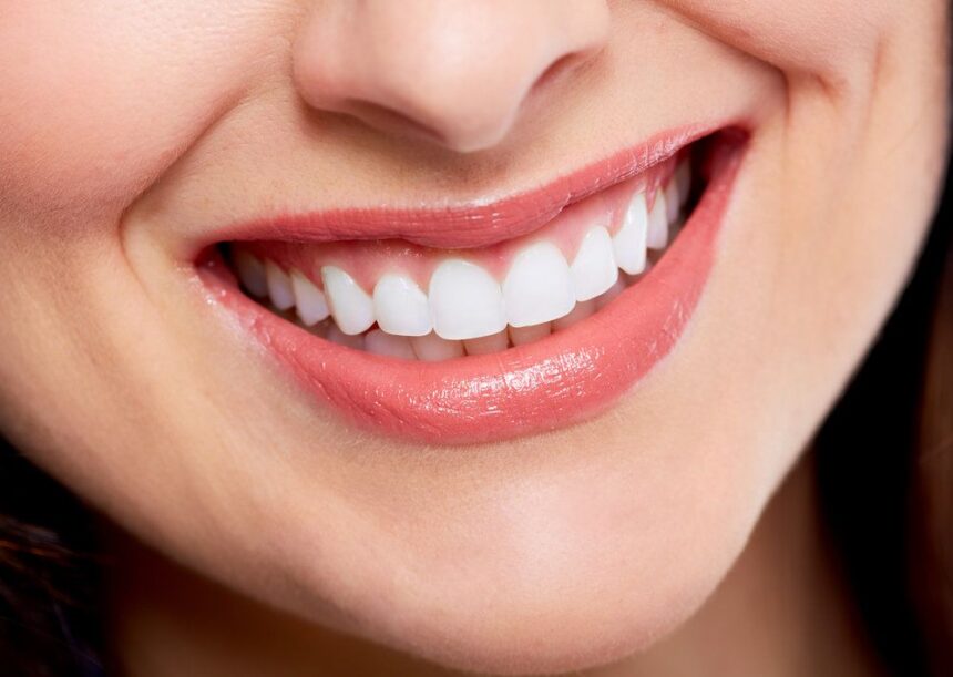 Smile Makeover