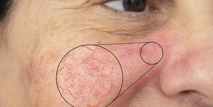 Spider Vein Removal