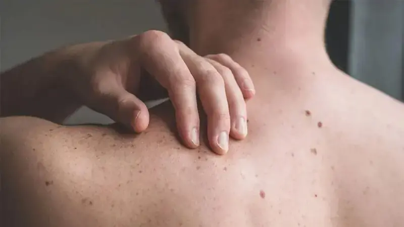 Various Skin Conditions