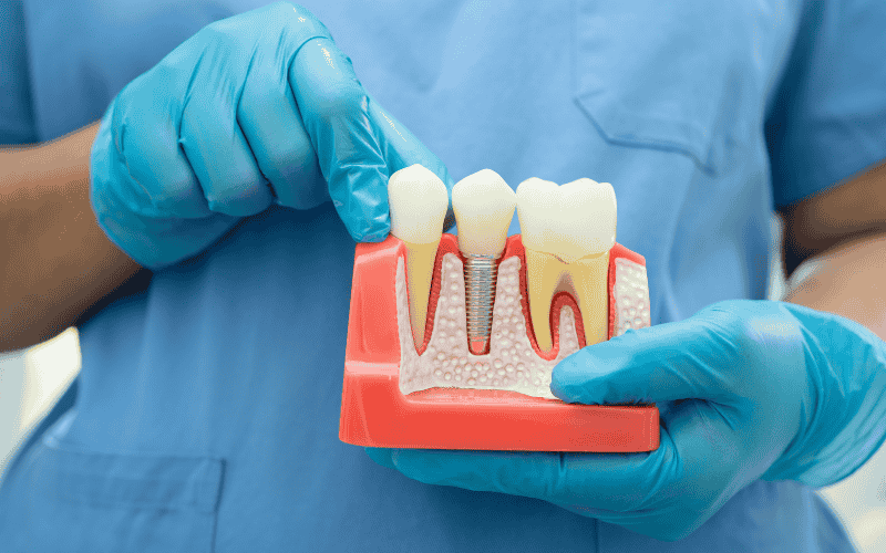 Advantages of Dental Implants