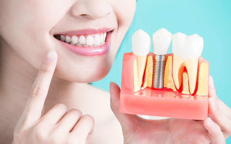 Dental Implants