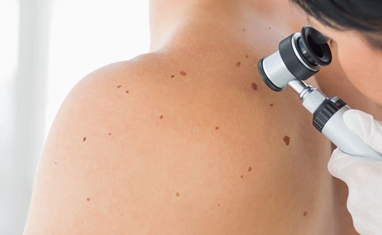 Role of a Dermatologist in Skin Cancer Prevention
