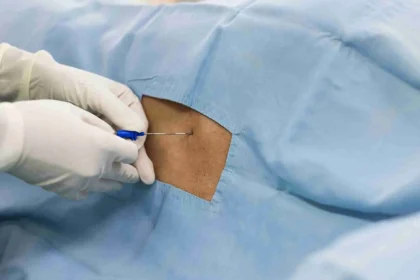 Epidural Injections
