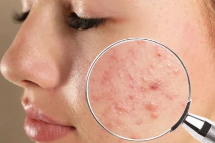 Methods for Managing Acne